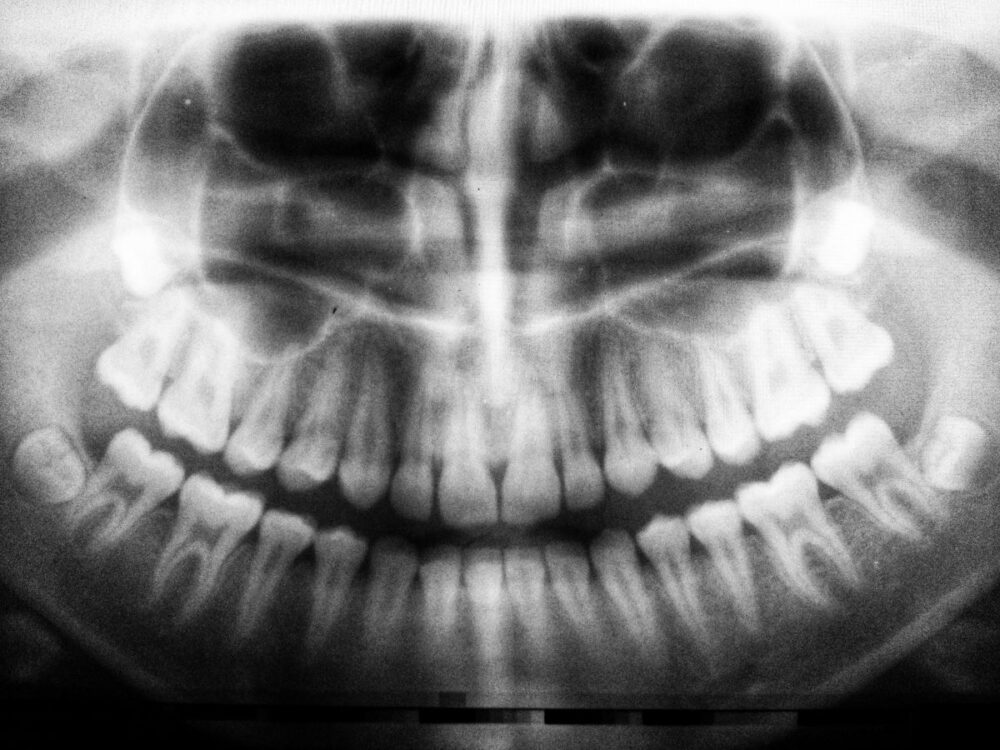 An x ray of teeth in black and white.